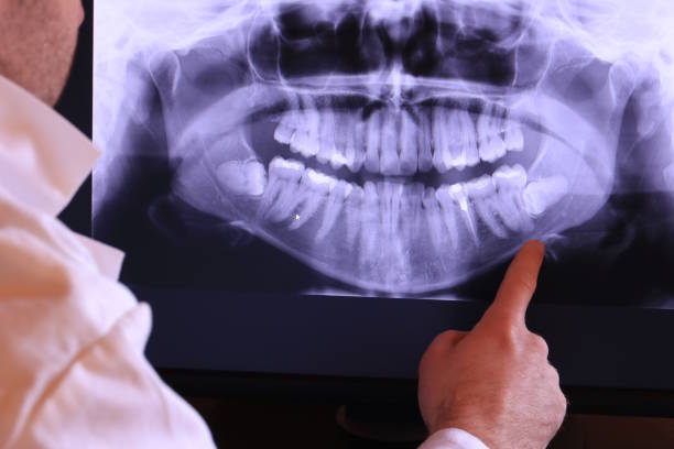 Best Emergency Tooth Extraction in Ben Wheeler, TX
